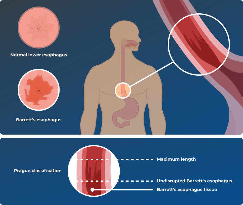 Diagram shows the Esophagus, a tube connecting the mouth to the stomach. Red Barrett's Esophagus tissue extends upward from the stomach into the Esophagus, where tissue is normally light pink.